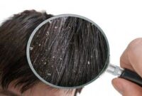 علت خشکی پوست و شوره سر چیست؟ علت خشکی پوست و شوره سر چیست؟